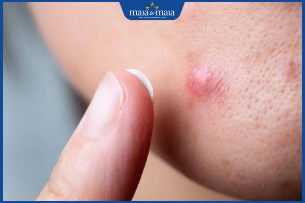 bôi thuốc trị nhọt ở mặt