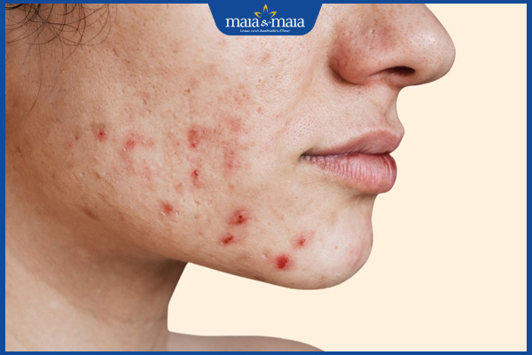 Uống vitamin E có bị nổi mụn không? Lợi ích và cách uống hiệu quả 3 bùng phát mụn