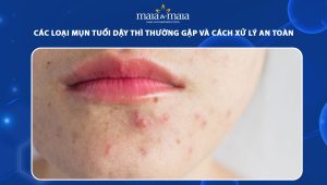 các loại mụn ở tuổi dậy thì