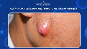 cách chữa mụn nhọt sưng to