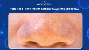 cách trị mụn cám