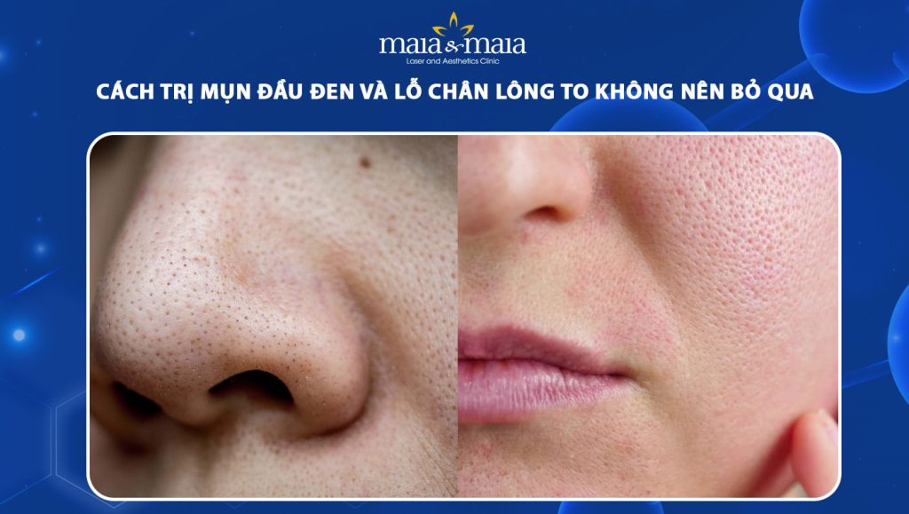 Cách trị mụn đầu đen và lỗ chân lông to không nên bỏ qua 1 cách trị mụn đầu đen và lỗ chân lông to
