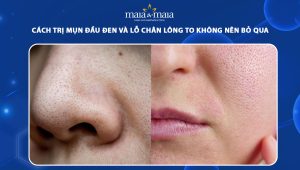 cách trị mụn đầu đen và lỗ chân lông to