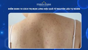 cách trị mụn lưng