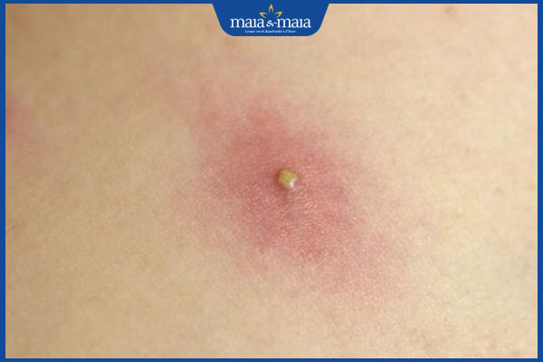 chẩn đoán mụn nhọt ở mông trẻ em