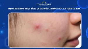 chữa mụn nhọt bằng lá cây