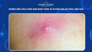 chữa mụn nhọt sưng to ở vùng kín