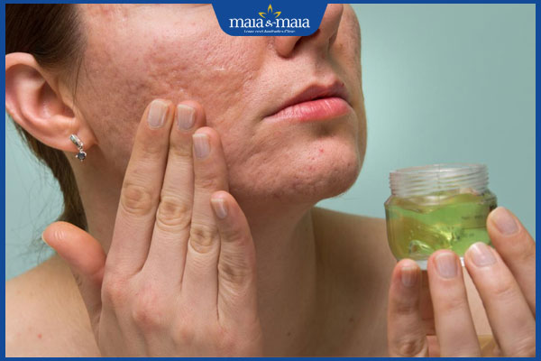 chữa nhọt bằng nguyên liệu tự nhiên