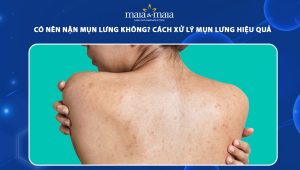 có nên nặn mụn lưng không