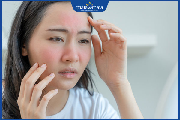 Lột mụn có nên đắp mặt nạ không? Nên dùng mặt nạ gì? 2 da ửng đỏ