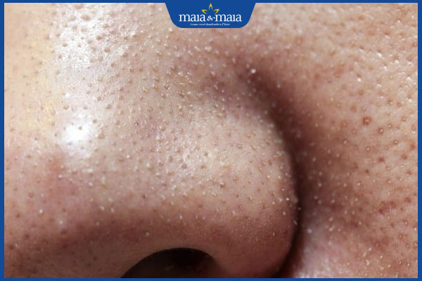 Tổng hợp 8 cách trị mụn cám hiệu quả không nên bỏ qua 2 đặc điểm mụn cám