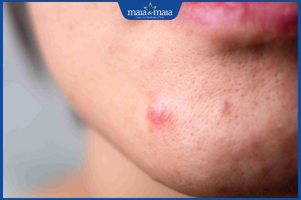 Mụn nhọt không có đầu là gì? Phương pháp điều trị hiệu quả 2 đặc điểm mụn nhọt không đầu