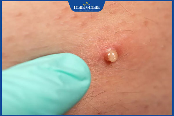 Mụn nhọt ở mông có đặc điểm gì? Cách điều trị hiệu quả 2 đặc điểm mụn nhọt