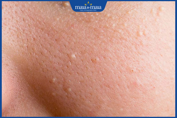 dấu hiệu mụn cám ở má