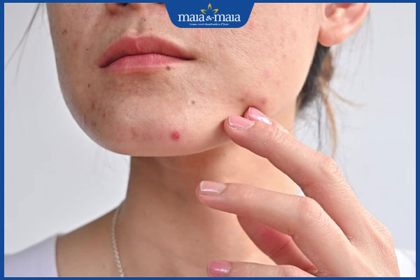 Mụn nhọt mùa hè: Dấu hiệu nhận biết và cách điều trị 2 dấu hiệu mụn nhọt mùa hè