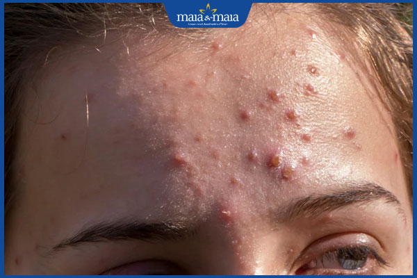 Nguyên nhân gây mụn nhọt ở trán và cách xử lý an toàn 2 dấu hiệu mụn nhọt ở trán