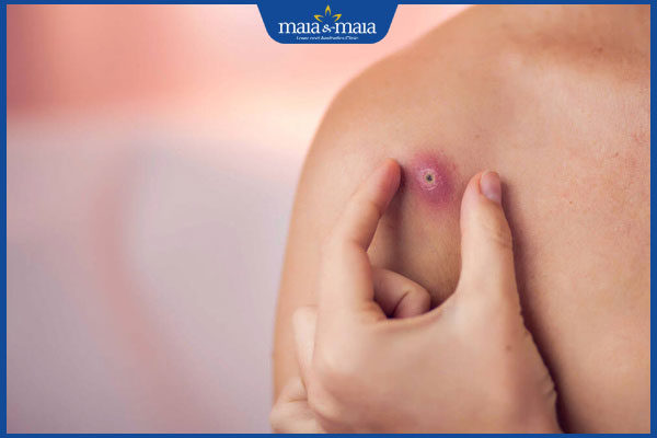 dấu hiệu mụn nhọt