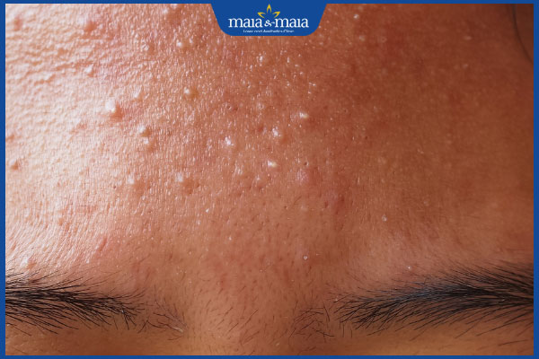 Mụn cám ở trán nguyên nhân do đâu? Cách nhận biết & điều trị 2 dấu hiệu nhận biết mụn cám ở trán