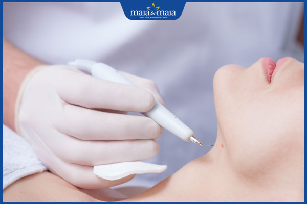 Trị hạt cơm bằng Plasma: Ưu nhược điểm và lưu ý khi điều trị 2 đốt hạt cơm bằng plasma