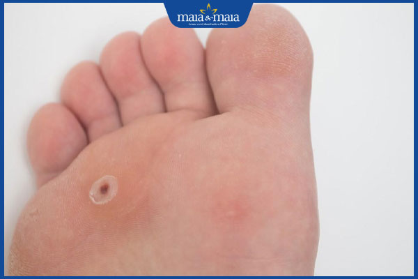 Trị hạt cơm bằng Plasma: Ưu nhược điểm và lưu ý khi điều trị 3 hạt cơm ở chân