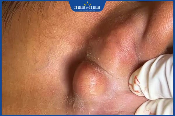 Mụn nhọt trong tai có nguy hiểm không? Điều trị như thế nào? 3 hình thành u ở tai