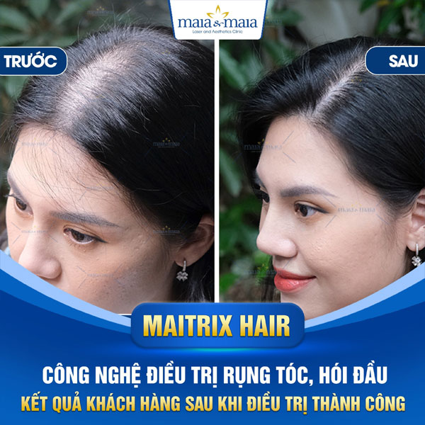 khách trị hói đầu nữ