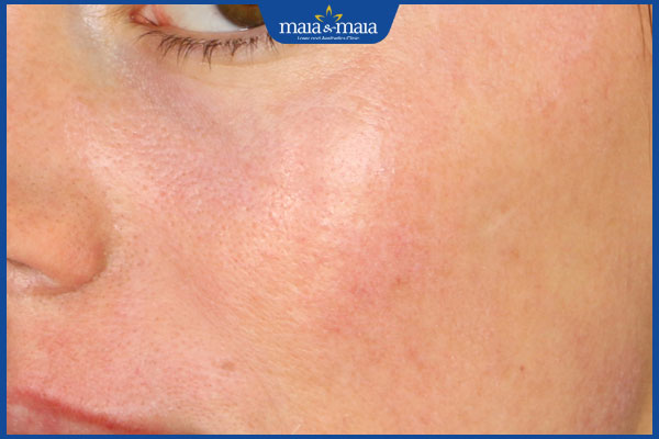 kích ứng sau khi lột mụn cám