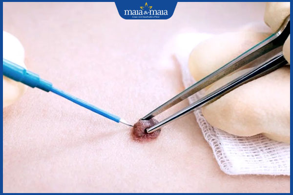 kỹ thuật đốt điện