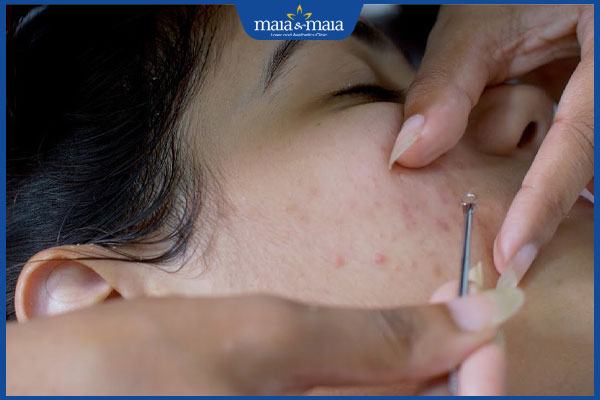 kỹ thuật lấy nhân mụn