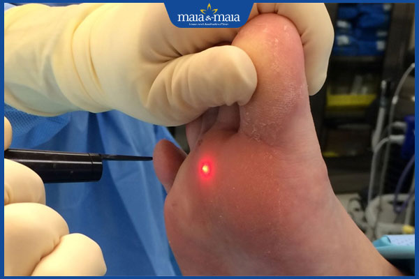 Đốt mụn cóc bằng laser tốt không? Địa chỉ thực hiện uy tín 4 laser co2 trị hạt cơm