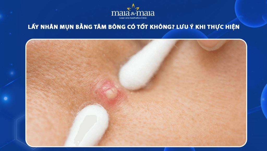lấy nhân mụn bằng tăm bông