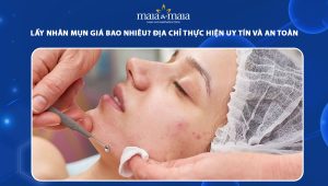 lấy nhân mụn giá bao nhiêu