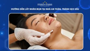 lấy nhân mụn tại nhà