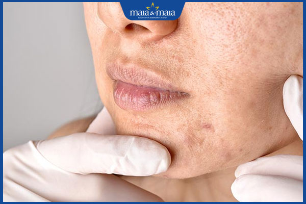 Cách trị mụn đầu đen và lỗ chân lông to không nên bỏ qua 2 lỗ chân lông bít tắc