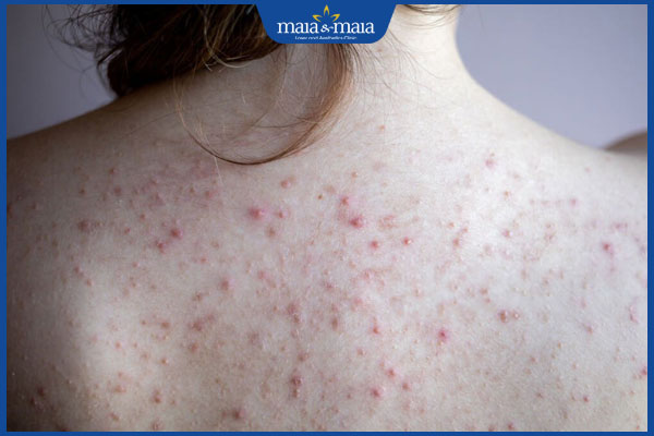 Trị mụn lưng bao nhiêu tiền? Yếu tố ảnh hưởng đến chi phí 2 lưng nổi nhiều mụn