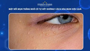 mặt nổi mụn trắng nhỏ