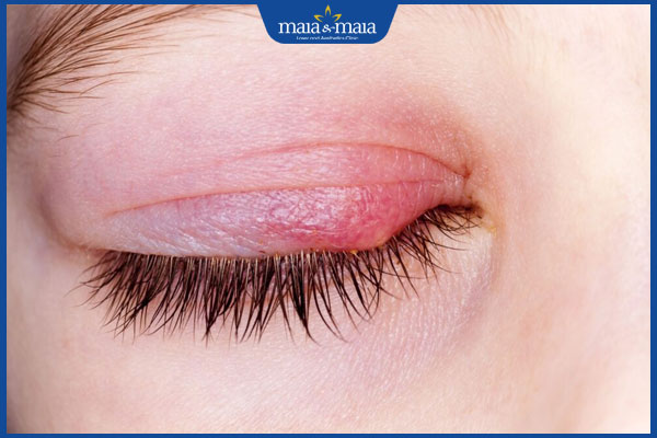 mí mắt sưng tấy