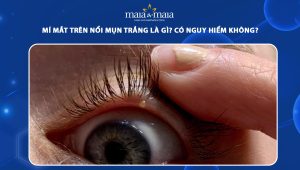 mí mắt trên nổi mụn trắng