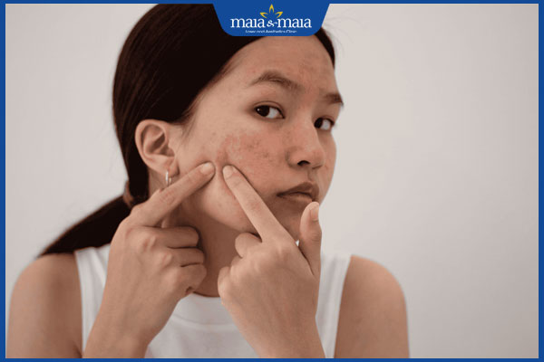 mọc mụn khi mang thai