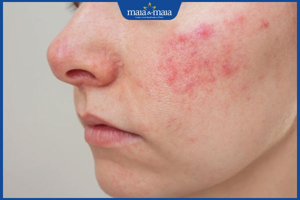 mụn bị đỏ ở má