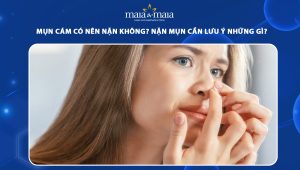mụn cám có nên nặn không