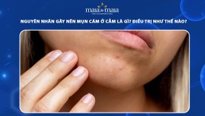 mụn cám ở cằm