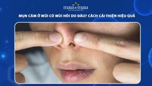 mụn cám ở mũi có mùi hồi