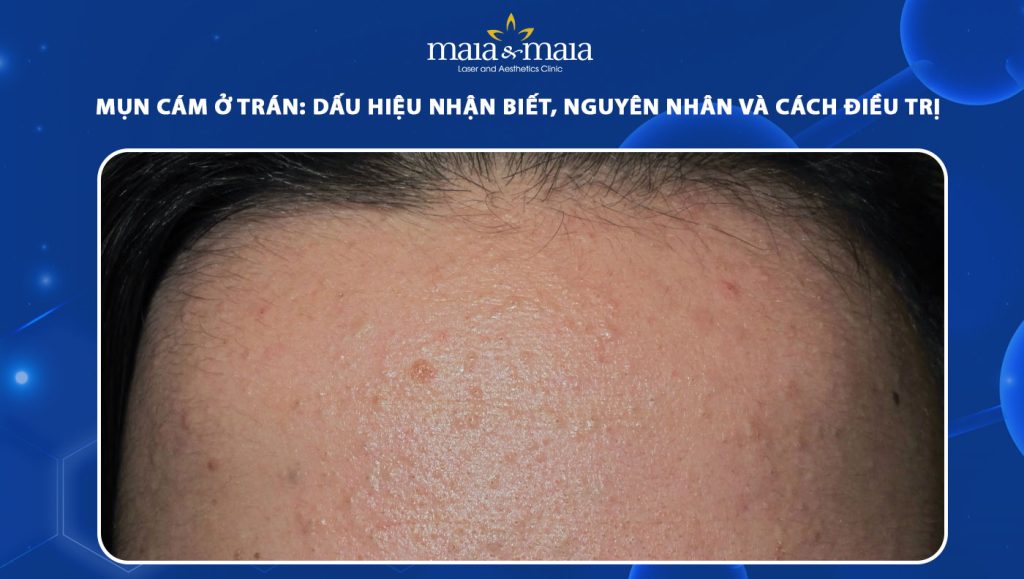 Mụn cám ở trán nguyên nhân do đâu? Cách nhận biết & điều trị 1 mụn cám ở trán