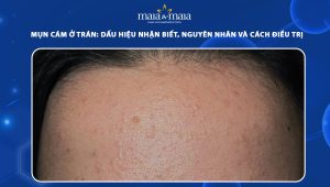 mụn cám ở trán
