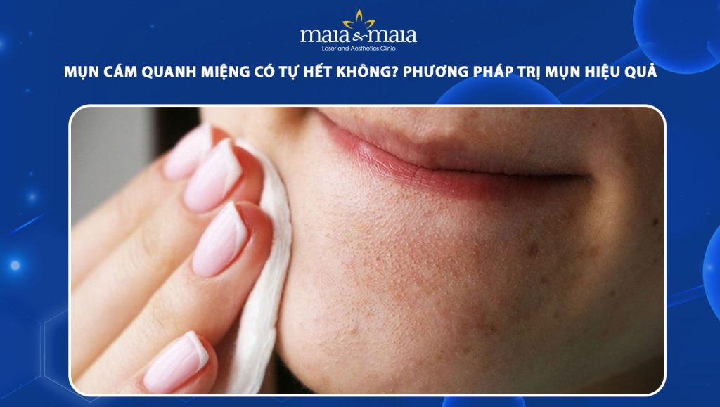 Mụn cám quanh miệng có tự hết không? Cách xóa mụn hiệu quả 1 mụn cám quanh miệng