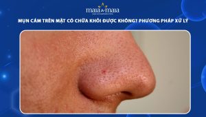 mụn cám trên mặt