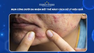 mụn cứng dưới da
