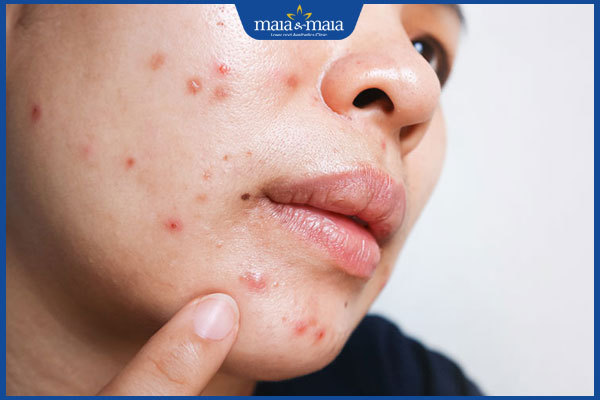 Mụn cứng dưới da nhận biết thế nào? Cách xử lý hiệu quả 3 mụn cứng ở miệng