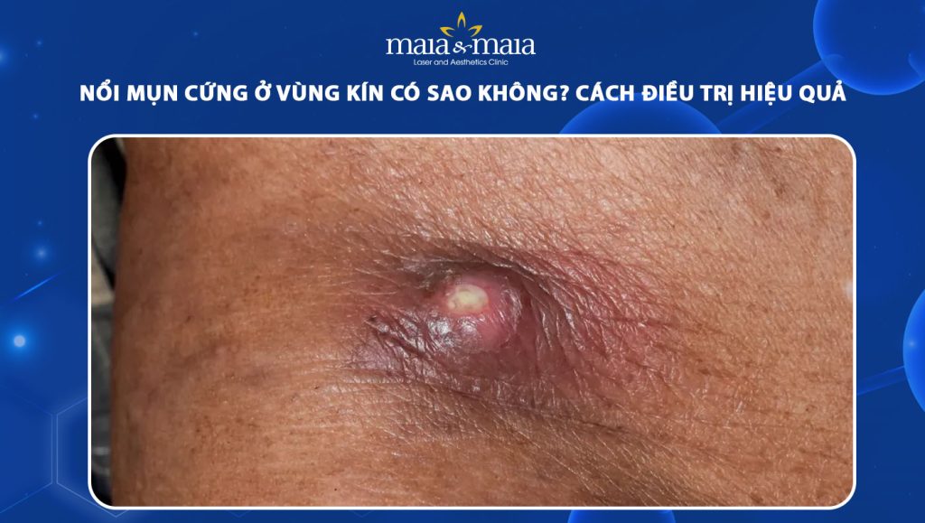 mụn cứng ở vùng kín